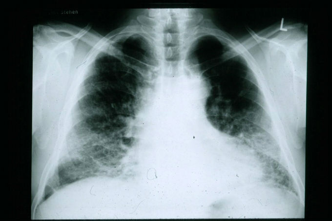 Xray of patient with Idiopathic Pulmonary Fibrosis
